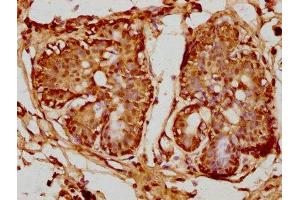 IHC image of ABIN7164990 diluted at 1:100 and staining in paraffin-embedded human breast cancer performed on a Leica BondTM system. (PSMB8 antibody  (AA 176-276))