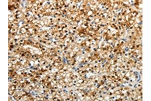 The image on the left is immunohistochemistry of paraffin-embedded Human renal cancer tissue using ABIN7190724(FZD2 Antibody) at dilution 1/25, on the right is treated with synthetic peptide.