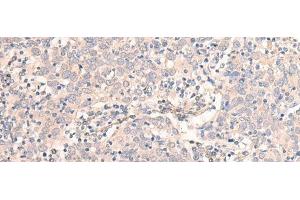 Immunohistochemistry of paraffin-embedded Human cervical cancer tissue using EMX1 Polyclonal Antibody at dilution of 1:25(x200) (EMX1 antibody)