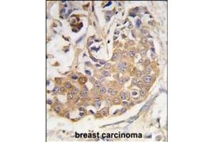 Formalin-fixed and paraffin-embedded human breast carcinoma tissue reacted with COL9A1 antibody (Center) (ABIN389244 and ABIN2839390) , which was peroxidase-conjugated to the secondary antibody, followed by DAB staining. (COL9A1 antibody  (AA 428-456))