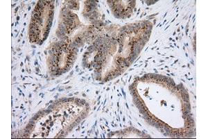 Immunohistochemical staining of paraffin-embedded Adenocarcinoma of Human colon tissue using anti-NXNL2 mouse monoclonal antibody. (NXNL2 antibody)
