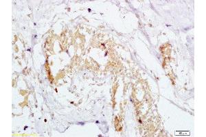 Formalin-fixed and human breast carcinoma tissue labeled with Anti-GTPBP10 Polyclonal Antibody , Unconjugated at 1:200 followed by conjugation to the secondary antibody and DAB staining