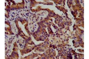 IHC image of ABIN7144824 diluted at 1:400 and staining in paraffin-embedded human lung cancer performed on a Leica BondTM system. (ATPAF1 antibody  (AA 58-143))