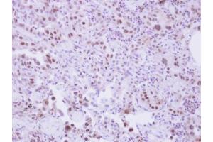 IHC-P Image Immunohistochemical analysis of paraffin-embedded human lung adenocarcinoma, using SLU7, antibody at 1:250 dilution.