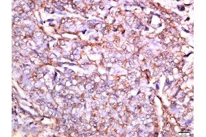 Paraformaldehyde-fixed, paraffin embedded human lung cancer, Antigen retrieval by boiling in sodium citrate buffer (pH6) for 15min, Block endogenous peroxidase by 3% hydrogen peroxide for 30 minutes, Blocking buffer (normal goat serum) at 37°C for 20min, Antibody incubation with Rabbit Anti-CHMP2B Polyclonal Antibodyy, Unconjugated at 1:200 overnight at 4°C, followed by a conjugated secondary and DAB staining. (CHMP2B antibody  (AA 31-120))