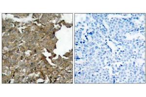 Immunohistochemical analysis of paraffin-embedded human breast carcinoma tissue using cofilin (Ab- 1022) antibody (E021164). (Cofilin antibody)