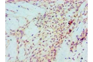 Immunohistochemical of paraffin-embedded Human breast cancer tissue using ABIN7172317 at dilution of 1:200. (p53 antibody)