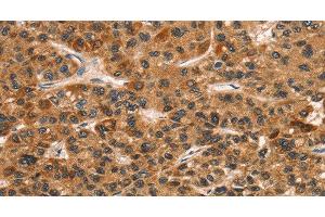 Immunohistochemistry of paraffin-embedded Human liver cancer tissue using CD159a/c Polyclonal Antibody at dilution 1:30 (CD159a/c antibody)