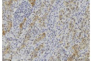 ABIN6273508 at 1/100 staining Human lung cancer tissue by IHC-P. (GZMK antibody  (Internal Region))