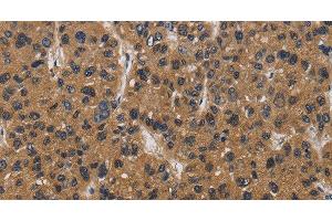 Immunohistochemistry of paraffin-embedded Human liver cancer tissue using E2F4 Polyclonal Antibody at dilution 1:40 (E2F4 antibody)