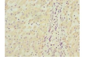Immunohistochemistry of paraffin-embedded human liver cancer using ABIN7160192 at dilution of 1:100 (MGLL antibody  (AA 1-303))