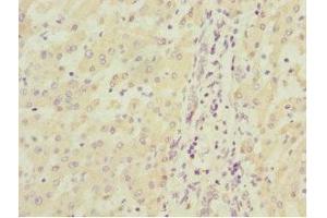 Immunohistochemistry of paraffin-embedded human liver cancer using ABIN7160192 at dilution of 1:100