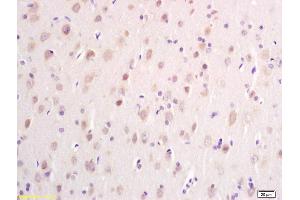 Formalin-fixed and paraffin embedded human glioma carcinoma labeled with Anti DTNB Polyclonal Antibody, Unconjugated (ABIN700630) at 1:200 followed by conjugation to the secondary antibody and DAB staining (Dystrobrevin beta antibody  (AA 261-370))