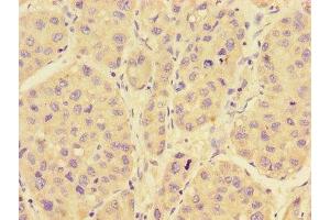 Immunohistochemistry of paraffin-embedded human liver cancer using ABIN7167280 at dilution of 1:100 (RAB28 antibody  (AA 98-218))