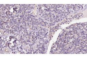 ABIN6273174 at 1/100 staining Human lymph cancer tissue by IHC-P. (Syntaxin 16 antibody  (N-Term))