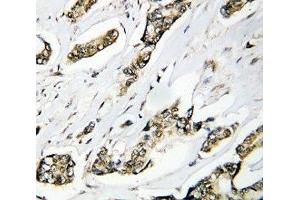 IHC-P: HSP105 antibody testing of human breast cancer tissue (HSPH1 antibody  (AA 713-733))