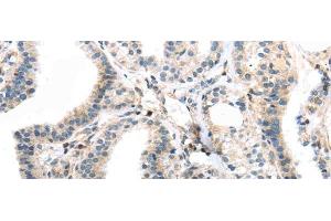 Immunohistochemistry of paraffin-embedded Human thyroid cancer using TBXA2R Polyclonal Antibody at dilution of 1/40