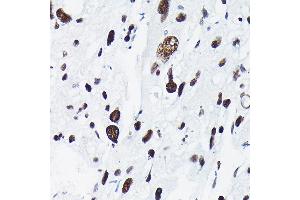 Immunohistochemistry of paraffin-embedded human liver cancer using Phospho-c-Jun-T91 Rabbit pAb (ABIN7268058) at dilution of 1:50 (40x lens). (C-JUN antibody  (pThr91))