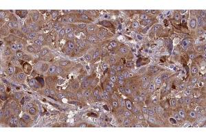 ABIN6273850 at 1/100 staining Human liver cancer tissue by IHC-P.
