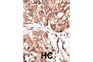 Formalin-fixed and paraffin-embedded human cancer tissue reacted with the primary antibody, which was peroxidase-conjugated to the secondary antibody, followed by AEC staining.