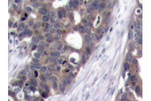 Immunohistochemistry analyzes of p70 S6K antibody in paraffin-embedded human breast carcinoma tissue. (RPS6KB1 antibody)