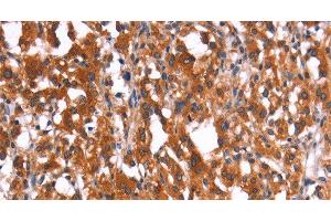 Immunohistochemistry of paraffin-embedded Human thyroid cancer using HMGCS2 Polyclonal Antibody at dilution of 1:40 (HMGCS2 antibody)