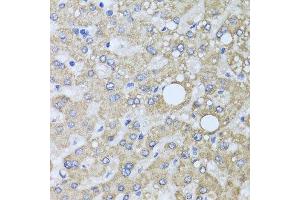Immunohistochemistry of paraffin-embedded human liver injury using AARS2 antibody at dilution of 1:100 (x40 lens). (AARS2 antibody)