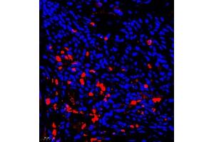 Immunofluorescence of paraffin embedded human liver cancer using AHSG (ABIN7073021) at dilution of 1:650 (400x lens) (Fetuin A antibody)