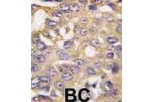 Formalin-fixed and paraffin-embedded human breast carcinoma tissue reacted with BRA1 antibody (N-term) (ABIN388572 and ABIN2849770) , which was peroxidase-conjugated to the secondary antibody, followed by DAB staining. (AMBRA1 antibody  (N-Term))