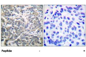 Immunohistochemical analysis of paraffin-embedded human breast carcinoma tissue using PRKAA1 polyclonal antibody . (PRKAA1 antibody)