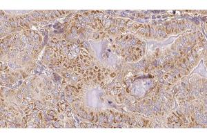 ABIN6267099 at 1/100 staining Human thyroid cancer tissue by IHC-P. (BIM antibody  (pSer77))