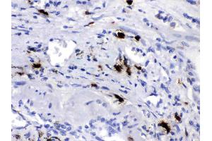 CPB2 was detected in paraffin-embedded sections of human lung cancer tissues using rabbit anti- CPB2 Antigen Affinity purified polyclonal antibody (Catalog # ) at 1 µg/mL. (CPB2 antibody  (AA 166-388))