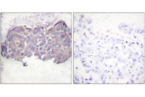 Immunohistochemistry analysis of paraffin-embedded human breast carcinoma, using HSL (Phospho-Ser552) Antibody. (LIPE antibody  (pSer552))