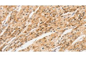 Immunohistochemistry of paraffin-embedded Human prostate cancer tissue using STAM Polyclonal Antibody at dilution 1:40