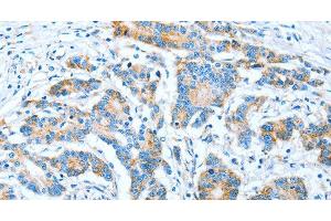 Immunohistochemistry of paraffin-embedded Human colon cancer using IMMT Polyclonal Antibody at dilution of 1:70