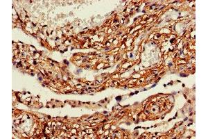 IHC image of ABIN7158511 diluted at 1:600 and staining in paraffin-embedded human lung cancer performed on a Leica BondTM system. (ACSL5 antibody  (AA 33-683))