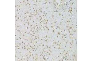 Immunohistochemistry of paraffin-embedded human leiomyoma of uterus using PRPF3 Antibody (ABIN5973192) at dilution of 1/100 (40x lens). (PRPF3 antibody)
