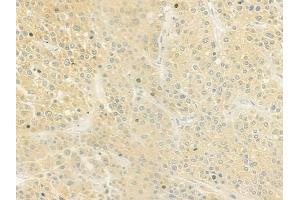 ABIN6259863 and ABIN6279104 at 1/100 staining human hepatocellular carcinoma by IHC-P. (AKR1C4 antibody  (N-Term))