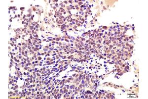 Formalin-fixed and paraffin embedded human lung carcinoma labeled with Anti-RNF56/CBLB Polyclonal Antibody, Unconjugated (ABIN760256) at 1:200 followed by conjugation to the secondary antibody and DAB staining.