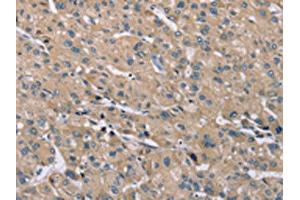 The image on the left is immunohistochemistry of paraffin-embedded Human liver cancer tissue using ABIN7192262(SAMD9L Antibody) at dilution 1/30, on the right is treated with synthetic peptide. (SAMD9L antibody)