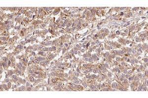 ABIN6279428 at 1/100 staining Human Melanoma tissue by IHC-P.