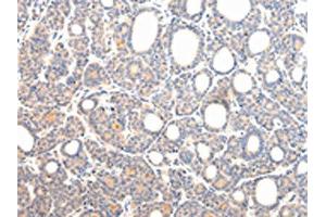 The image on the left is immunohistochemistry of paraffin-embedded Human thyroid cancer tissue using ABIN7131592(VPS54 Antibody) at dilution 1/20, on the right is treated with fusion protein.