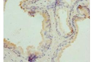 Immunohistochemistry of paraffin-embedded human prostate cancer using ABIN7173912 at dilution of 1:100 (TPD52L1 antibody  (AA 1-144))