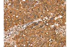 The image on the left is immunohistochemistry of paraffin-embedded Human breast cancer tissue using ABIN7130892(RNASET2 Antibody) at dilution 1/30, on the right is treated with fusion protein. (RNASET2 antibody)