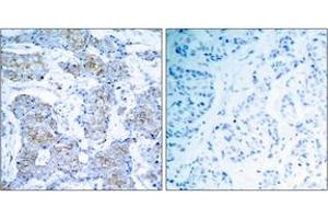 Immunohistochemistry analysis of paraffin-embedded human breast carcinoma tissue, using HER2 (Ab-1248) Antibody. (ErbB2/Her2 antibody  (AA 1206-1255))