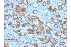 Formalin-fixed, paraffin-embedded human thyroid carcinoma stained with Occludin Mouse Monoclonal Antibody (OCLN/2181). (Occludin antibody  (AA 282-415))