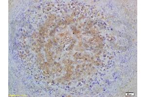Formalin-fixed and paraffin embedded mouse lymphoma labeled with Anti-Smad3 Polyclonal Antibody, Unconjugated (ABIN747023) at 1:200 followed by conjugation to the secondary antibody and DAB staining (Smad2/3 antibody  (AA 30-80))