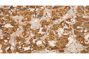 Immunohistochemistry of paraffin-embedded Human thyroid cancer tissue using RBBP8 Polyclonal Antibody at dilution 1:65 (Retinoblastoma Binding Protein 8 antibody)